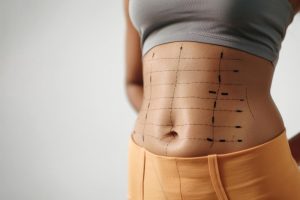 Karın Germe (Abdominoplasti)